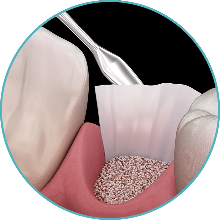 bone grafting 3d