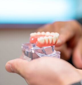 implant-supported denture model