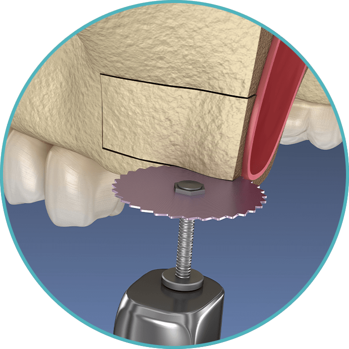 ridge augementation 3d