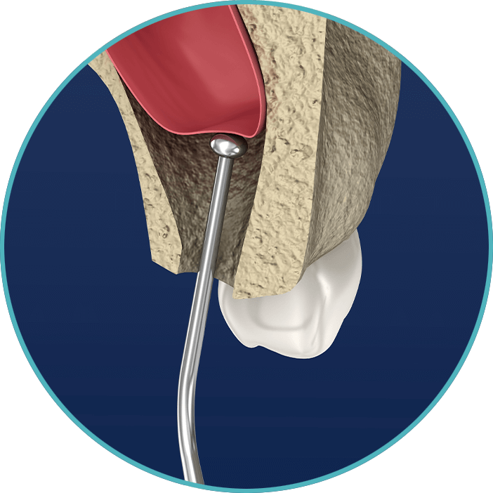 sinus lift 3d