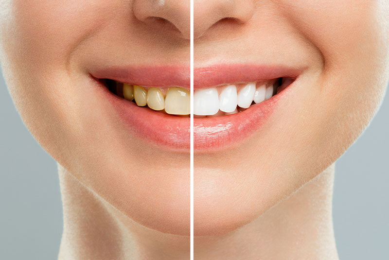 teeth whitening