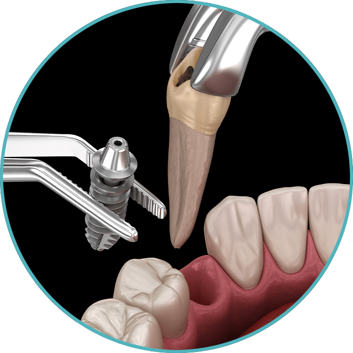 tooth extraction with new dental implant