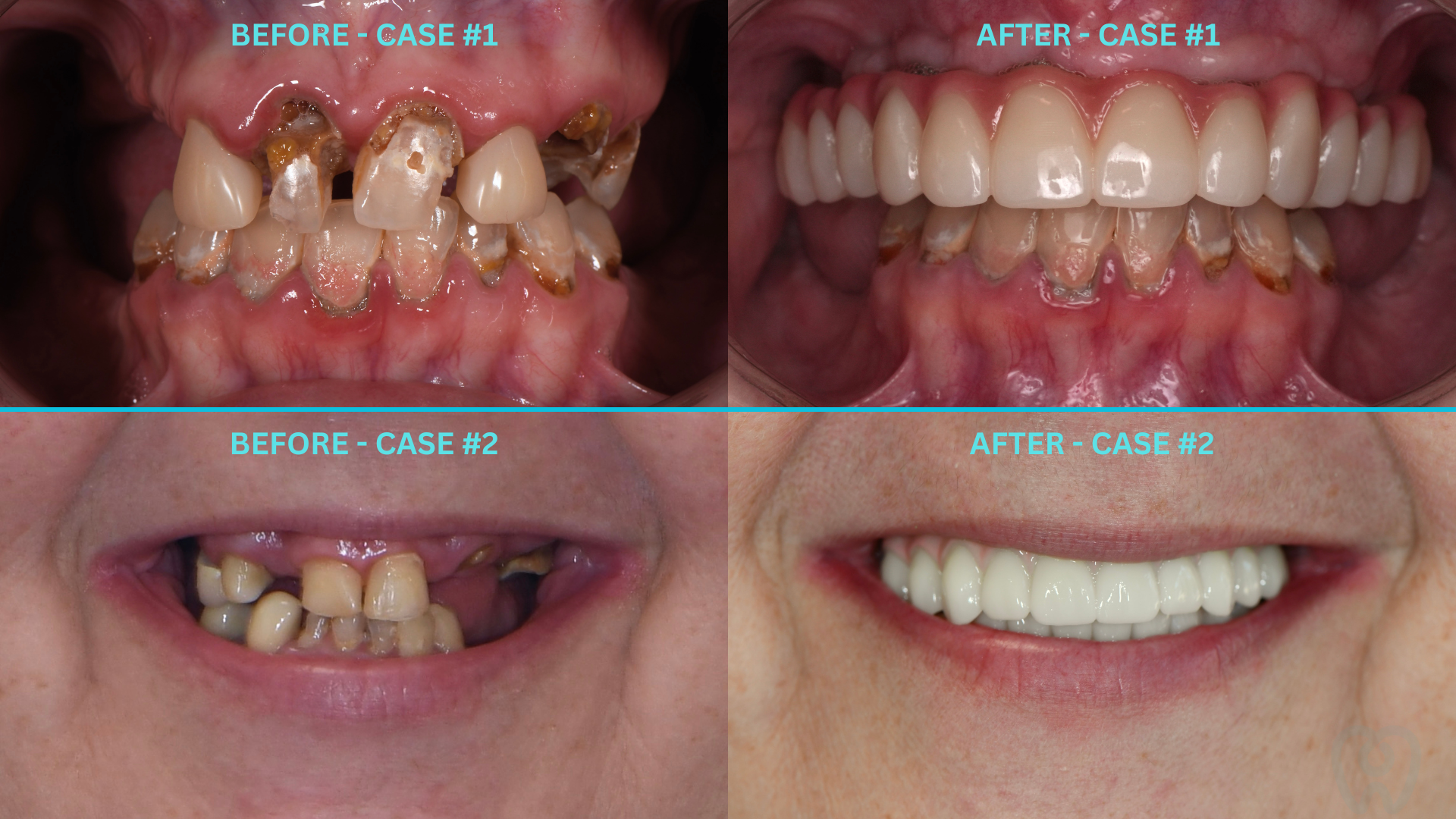 Before and after full arch dental implant results – All-on-X treatment case by Q Dental in Champaign, IL